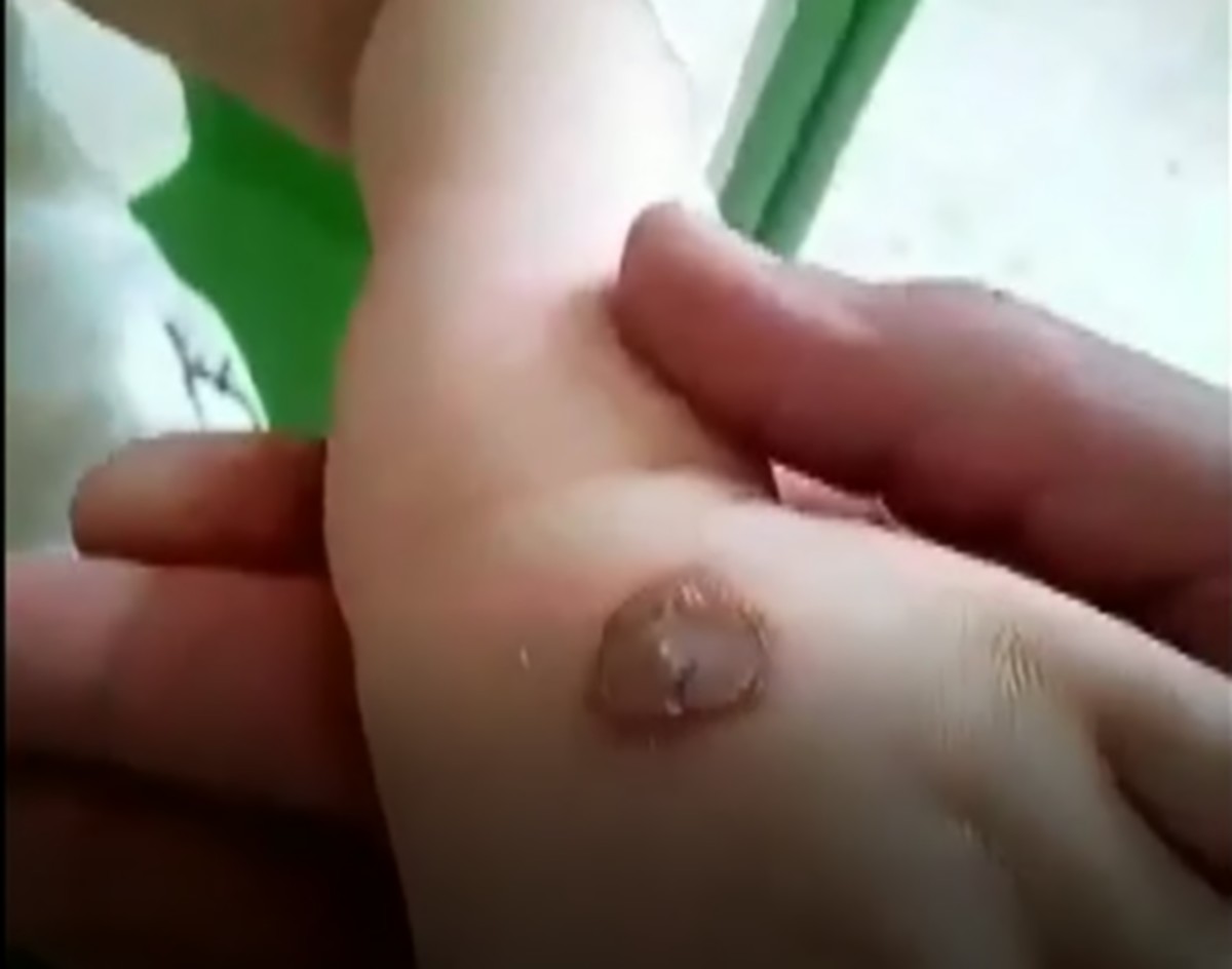 حسب شهادة والدها :بالفيديو طفلة بصفاقس تتعرّض للحرق من طرف والدتها