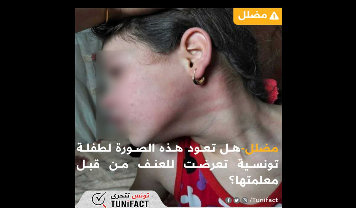 مضلل-هل تعود هذه الصورة لطفلة تونسية تعرضت للعنف من قبل معلمتها؟